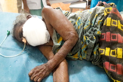 A patient got admitted and treated for cancer cheek resulting in chronic ulcer with maggots
