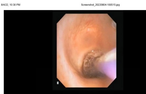intrathoracic_3